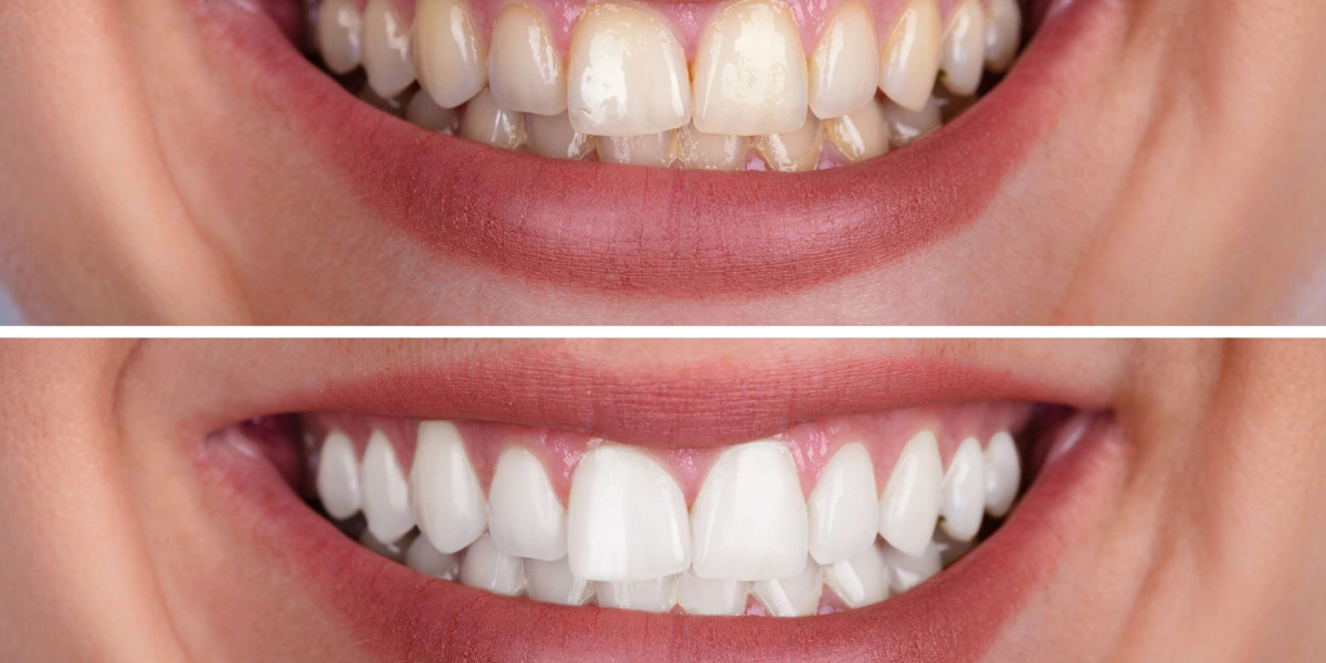 The Role of Oral Hygiene Before and After Whitening