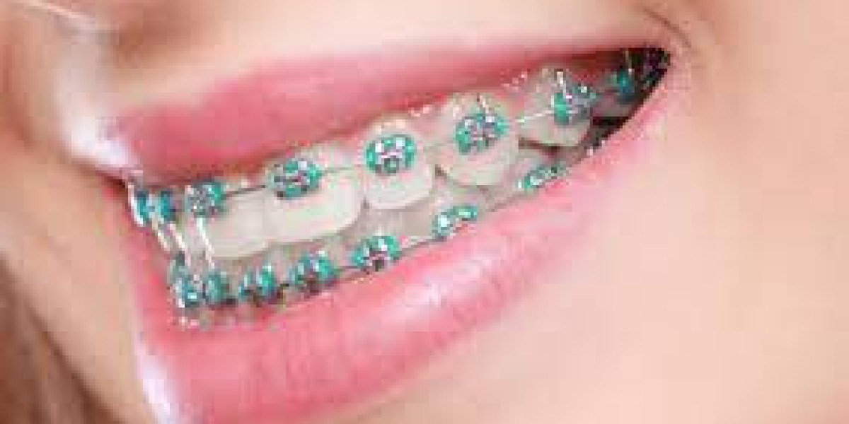 Top Benefits of Dental Braces for Your Teeth